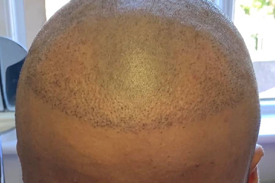 L&rsquo;alcool et la greffe de cheveux CHOI font-ils bon ménage ?